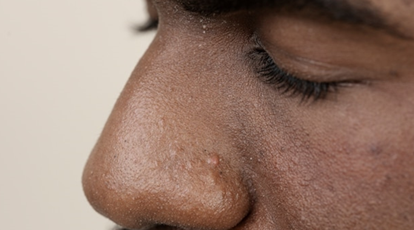 Oily skin deals men