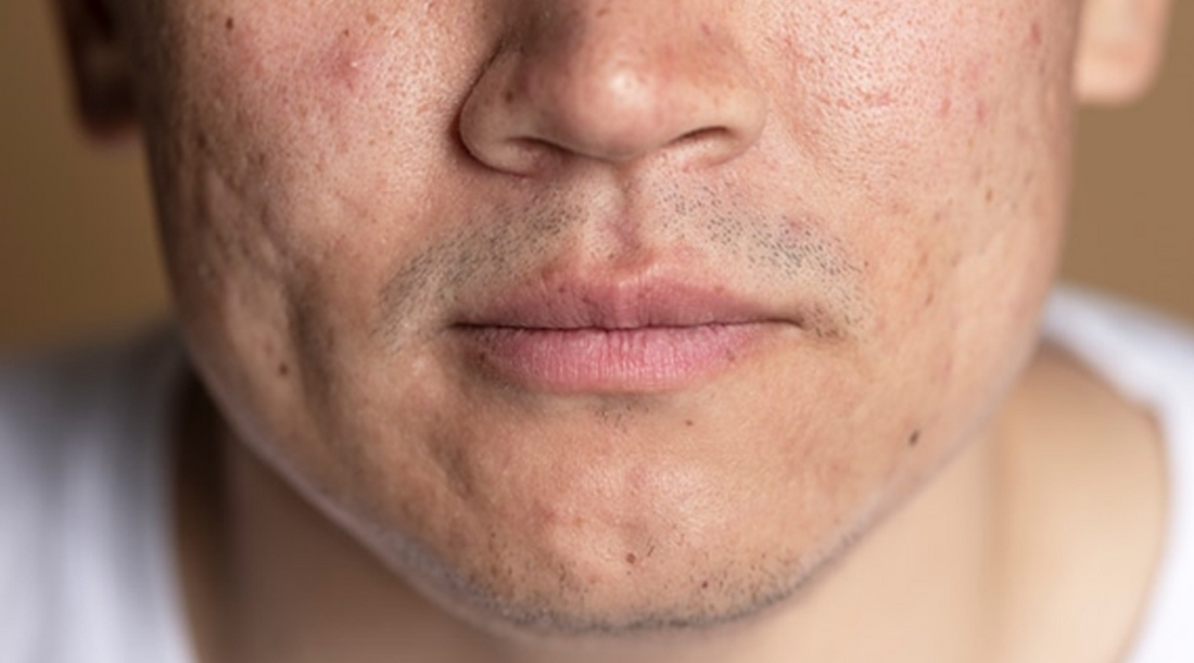 The Power of Ginseng: A Natural Solution for Men's Acne-Prone Skin
