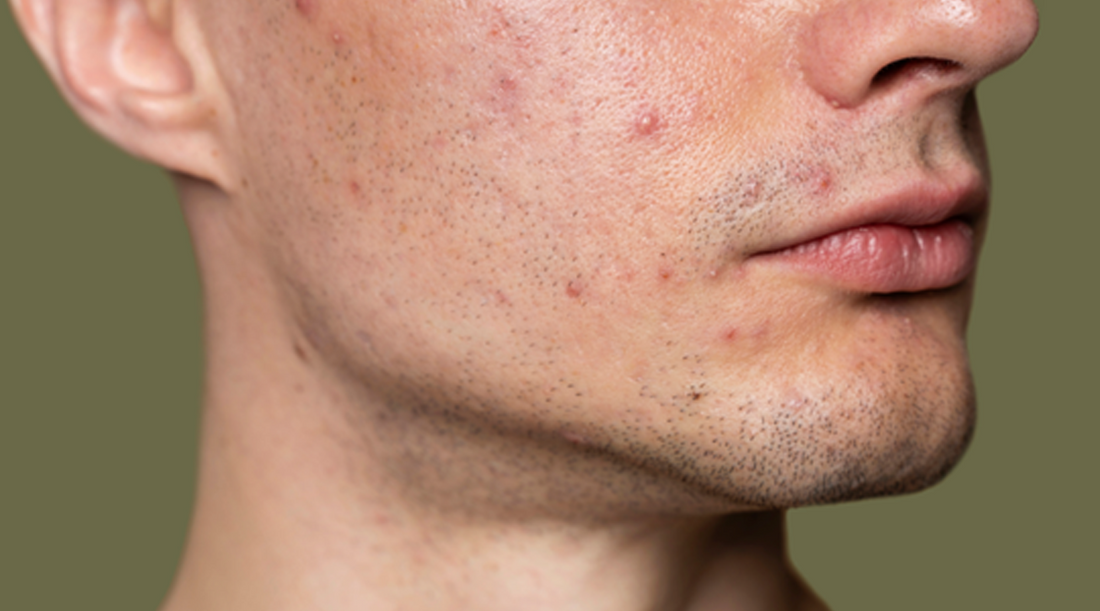 Achieving Clear Skin The Benefits of Retinol and Azelaic Acid