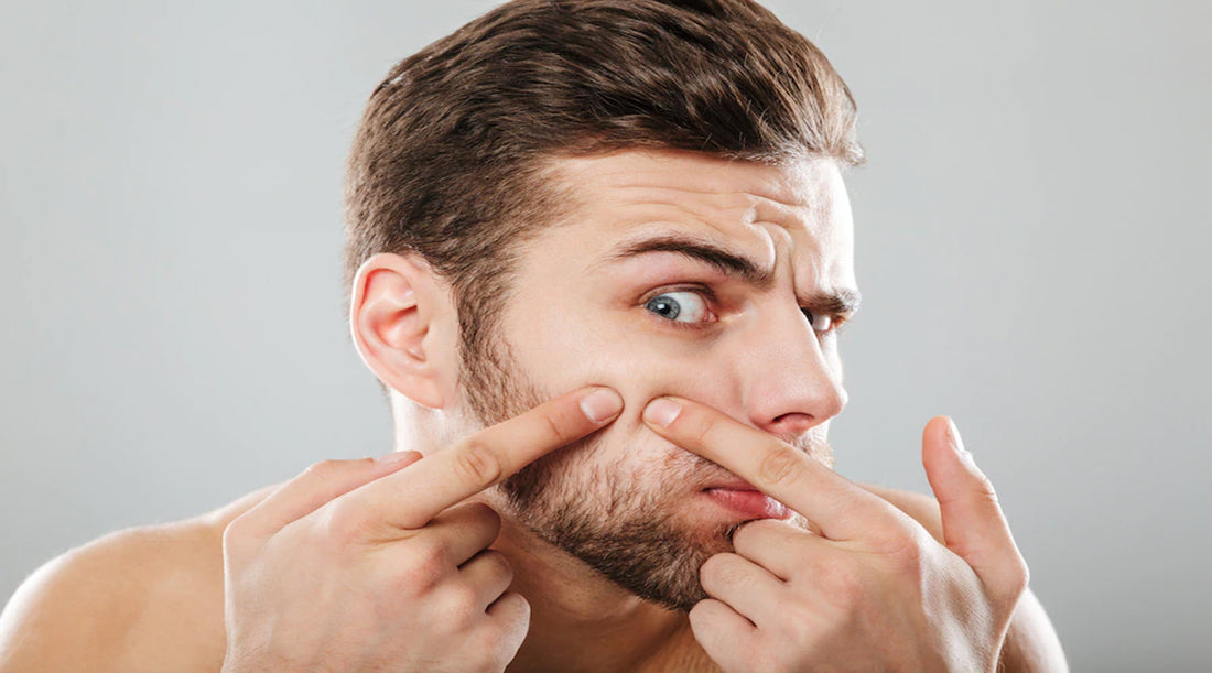 <a href="https://www.freepik.com/free-photo/close-up-portrait-man-squeezing-pimples_6730362.htm#query=men%20skincare%20acne&position=15&from_view=search&track=sph">Image by drobotdean</a> on Freepik