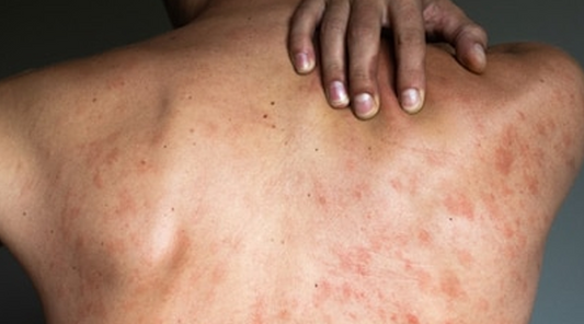 Body Acne in Men: Causes, Treatment, and Prevention
