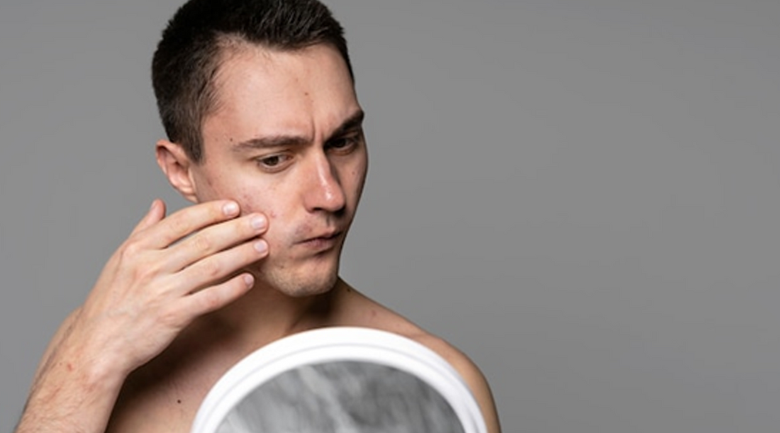 Natural Acne Remedies for Men: Banishing Breakouts Naturally