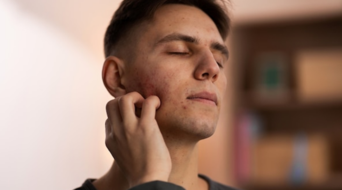 Post-Acne Care: Healing and Preventing Scarring in Men