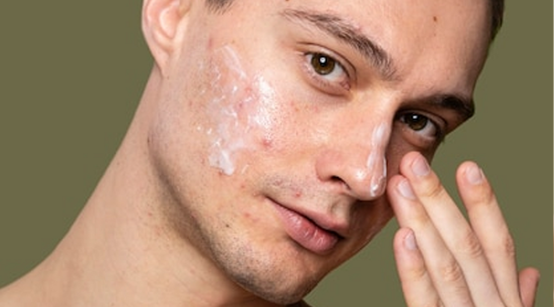 Say Goodbye to Acne and Wrinkles: The Power of Niacinamide for Men