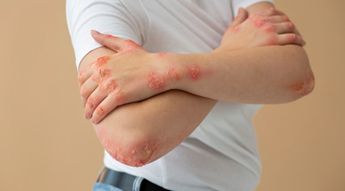 Say Goodbye to Irritated Skin with Kukui Nut Oil: The Ultimate Solution for Men with Eczema
