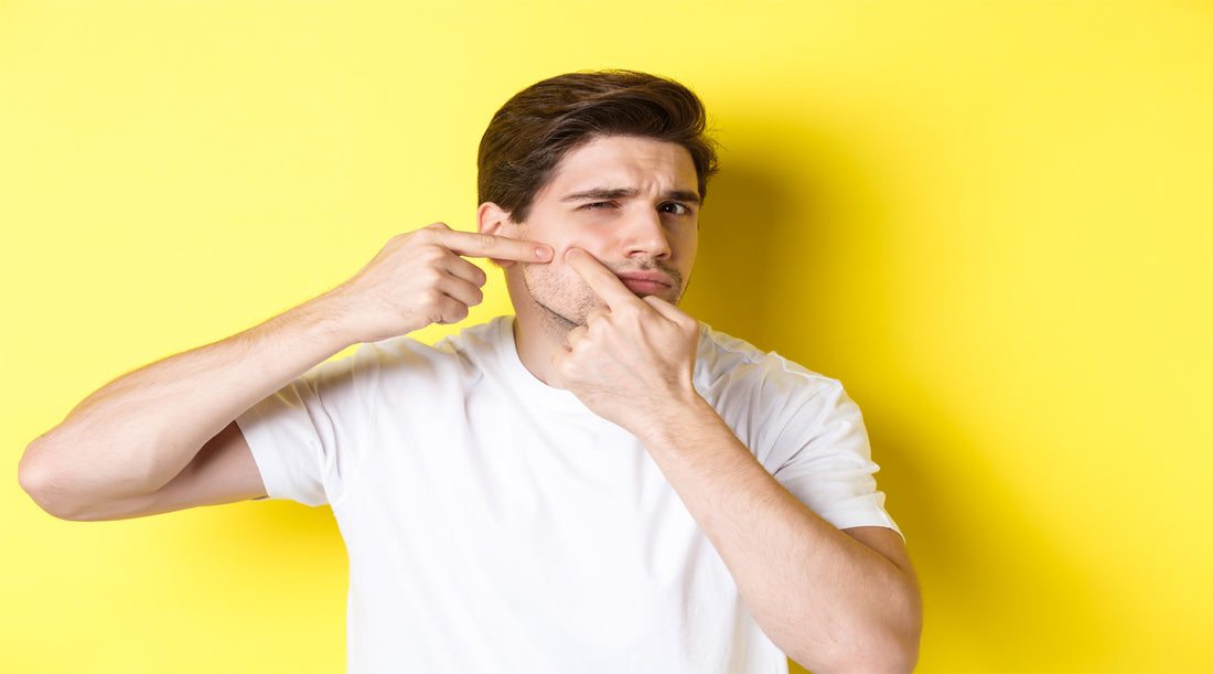 <a href="https://www.freepik.com/free-photo/young-man-pop-pimple-cheek-standing-yellow-background-concept-skin-care-acne_13084537.htm#query=men%20skincare%20acne&position=2&from_view=search&track=sph">Image by benzoix</a> on Freepik