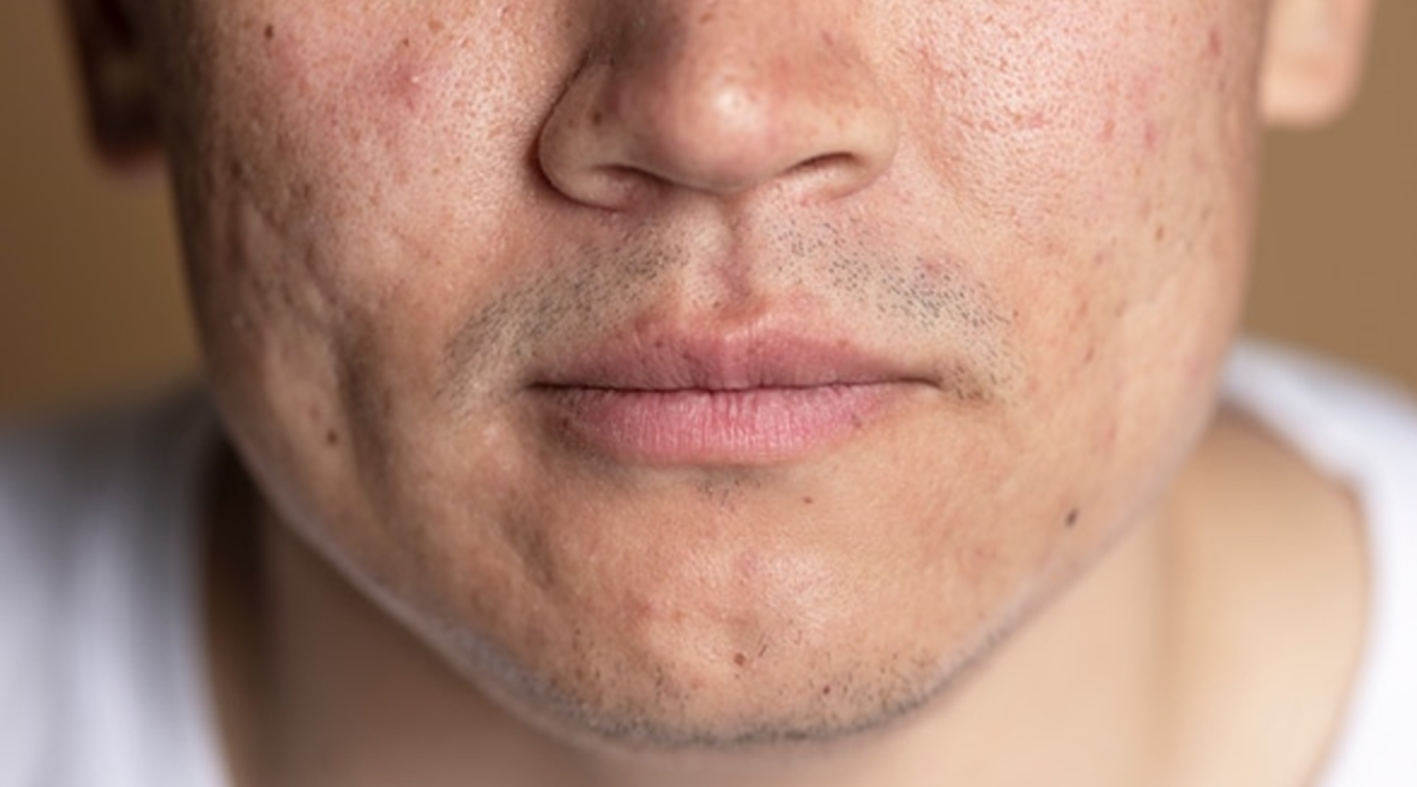 The Benefits of BetaGlucan in Men's Acne Skincare Assembled Skincare