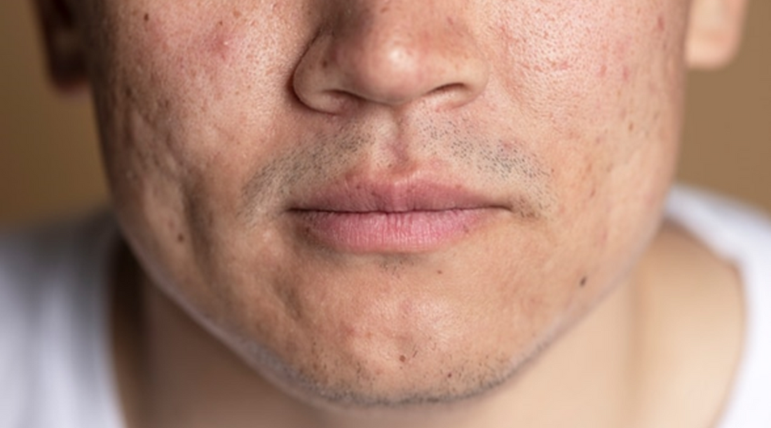 The Benefits of Beta-Glucan in Men's Acne Skincare