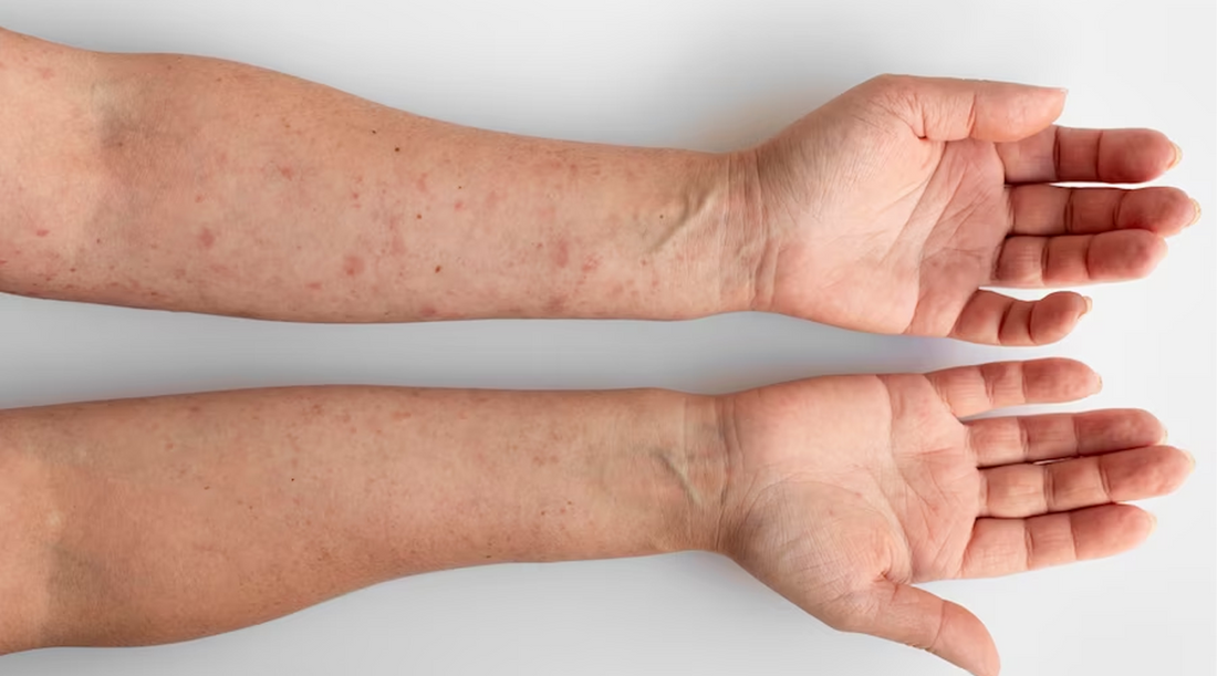The Healing Power of Willow Bark Extract: A Natural Remedy for Men with Eczema and Psoriasis