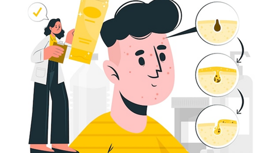 The Natural Solution: How Bakuchiol Can Transform Men's Acne-Prone Skin