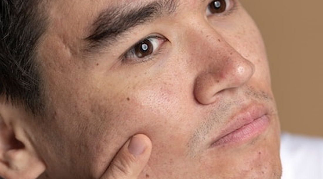 The Secret to Banishing Dark Circles: Why Men's Skincare Needs Phytonadione (Vitamin K)