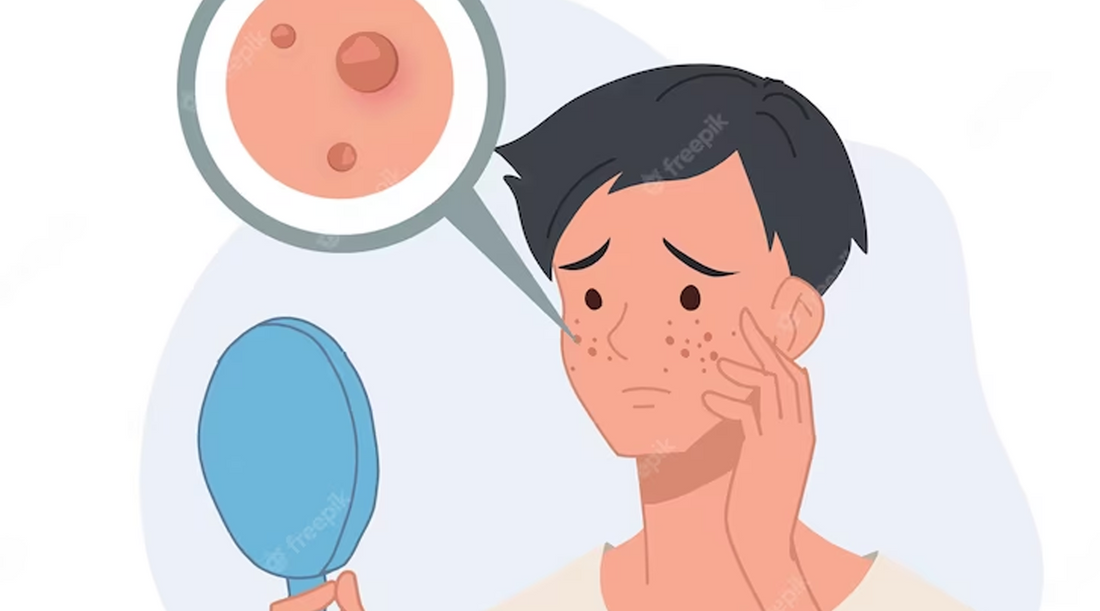 The Ultimate Guide to Squalene Oil: A Natural Remedy for Acne in Men