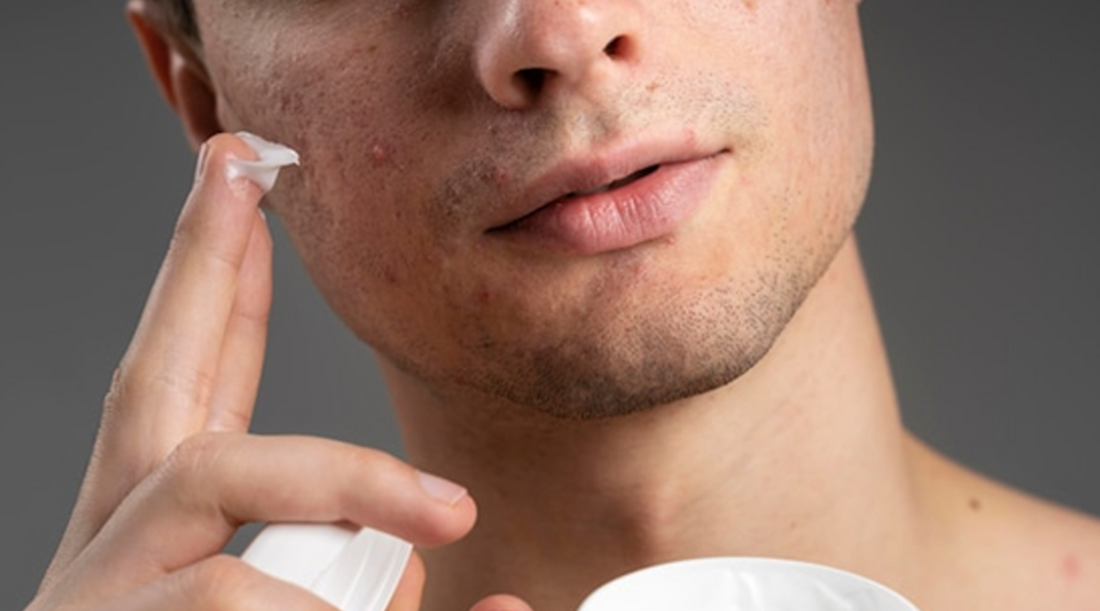 Unlocking Clear Skin: Men's Acne Solutions for 2024