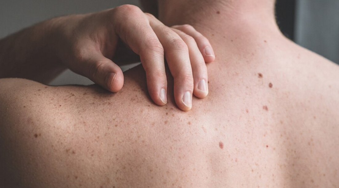 Unlocking the Healing Properties of Squalene Oil for Men's Eczema and Psoriasis