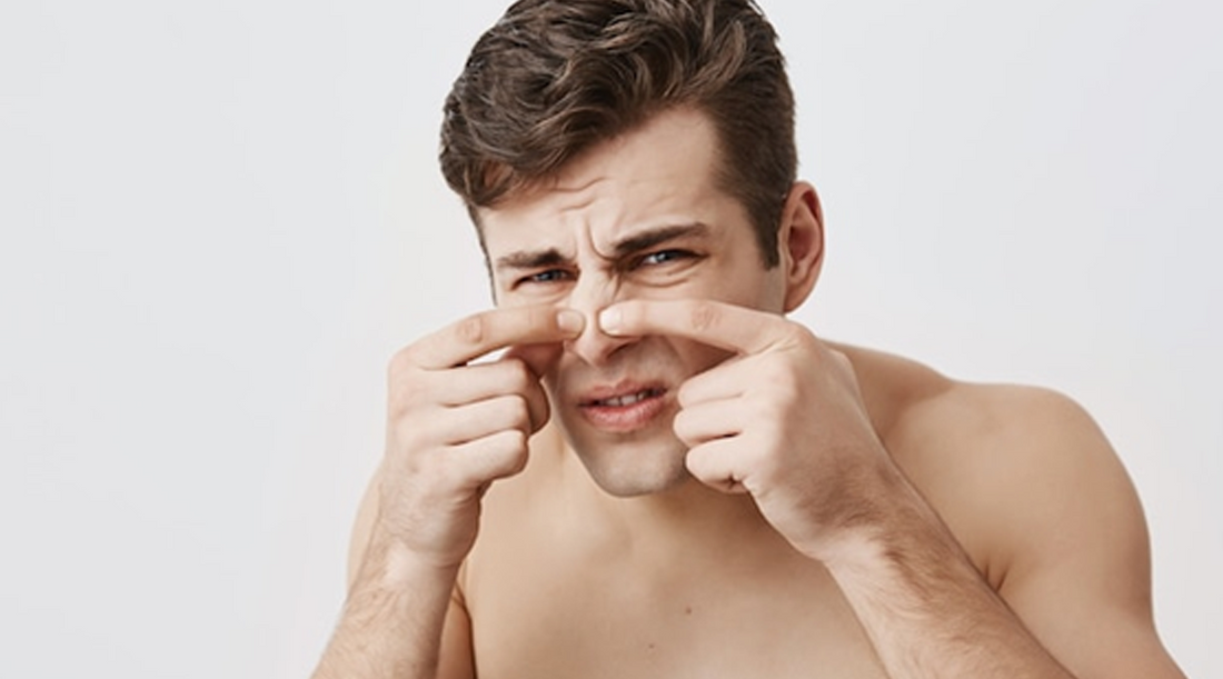 Unveiling the Power of Willow Bark Extract: A Natural Solution for Men with Large Pores and Blackheads