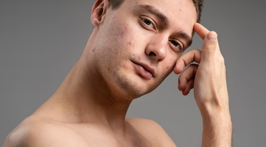 Willow Bark Extract: A Promising Treatment for Acne-Prone Skin in Men