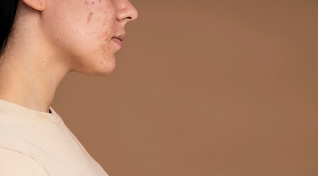 Men Skincare: Harnessing the Power of Witch Hazel for Acne Control