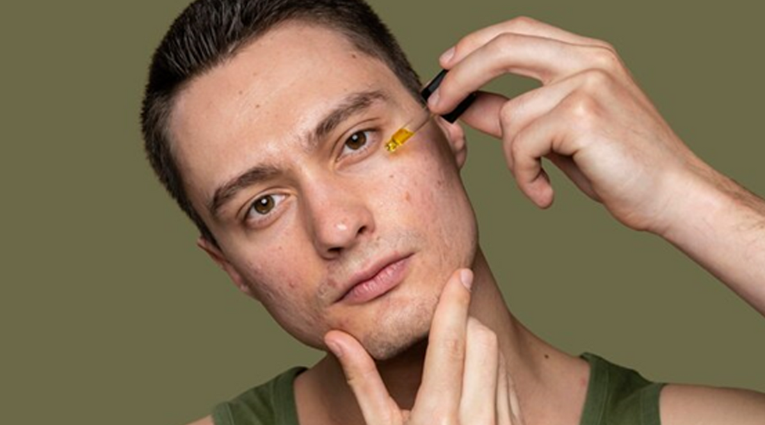 The Ultimate Guide to Men's Skincare: Harnessing the Power of Witch Hazel for Acne-Free Skin