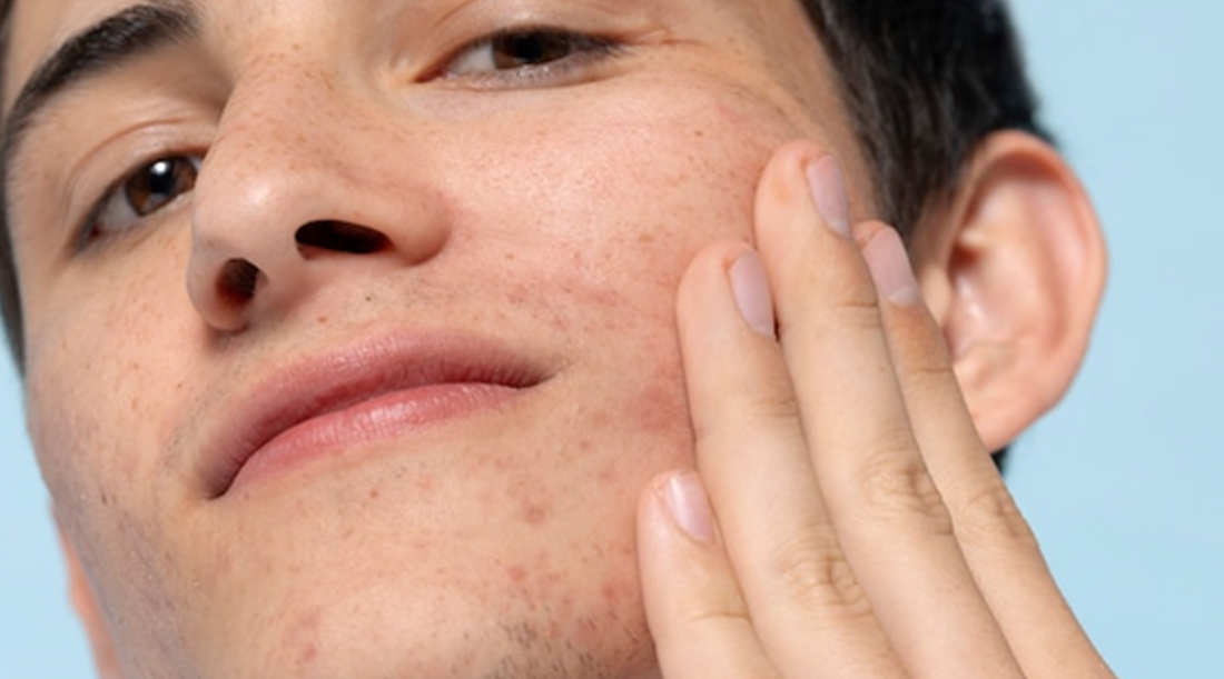 Men Skincare: A Comprehensive Guide to Acne and Achieving Flawless Skin